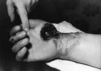 Fig. 1Deep injuries due to passage of electric current in radiocarpal area (same view on both sides).