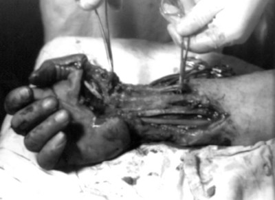 Fig. 2Eschar excision in radiocarpal area on day 2 of treatment.