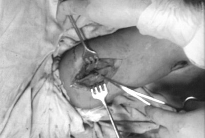 Fig. 3Clear evidence of thrombi in brachial artery.