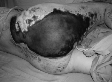 Fig. 3Deep second- to third-degree burn wounds in right buttock and posterior thigh (about 7% TBSA).