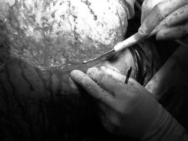 Fig. 4Irregular wound edge well debrided with VersajetTM system.