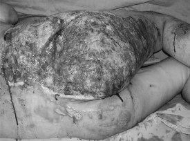 Fig. 5Healthy and viable wound bed with active punctual bleeding.