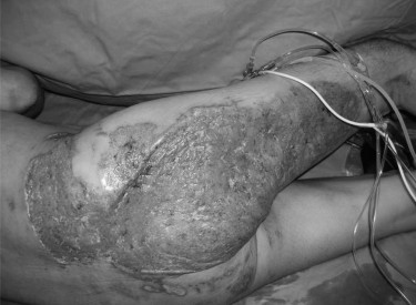 Fig. 6Clean wound with good re-epithelialization on day 8 post-op.