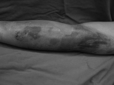 Fig. 8Necrotic dermis can be removed with the water jet system, sparing viable underlying dermis.