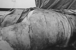 Fig. 2Burn wound in the buttocks tangentially excised on day 5 post-burn, covered immediately with E.Z. Derm.