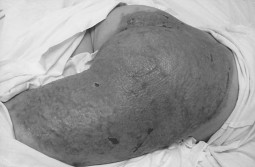 Fig. 4One month post-operative. Stable wound healing achieved.