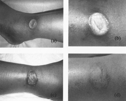 Fig. 2a) Upper left: deep infrared burn right ankle lateral aspect. b) Upper right: closer view at a later stage. c) Lower left: few days after debridement and skin grafting. d) Lower right: after 6 month grafting.