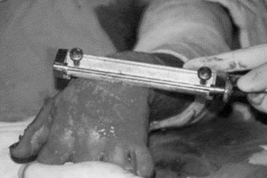 P1bExcision-greffe pr�coce.