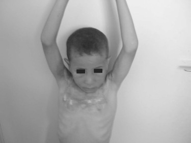 P2cAspect post-op�ratoire en ant�pulsion.