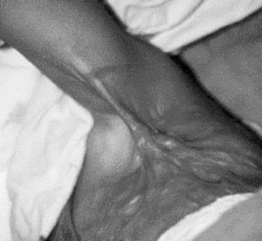 P4aBride du pilier post�rieur du creux axillaire.