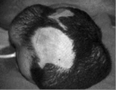 P5aAlop�cie cicatricielle.