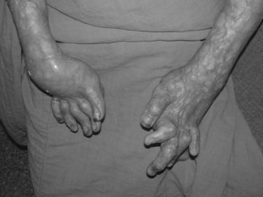 P6aS�quelles majeures de br�lure du dos des mains.