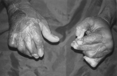 P7cAspect post-op�ratoire