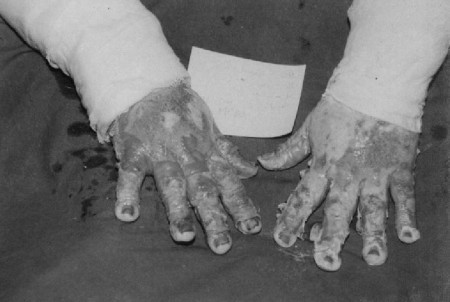 Fig. 1Bilateral burned hands (right hand treated with MEBO, left hand with 1% SSD).