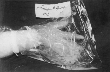 Fig. 2Acute partial-thickness burned hand kept freely mobile in sterile polyethylene bag.