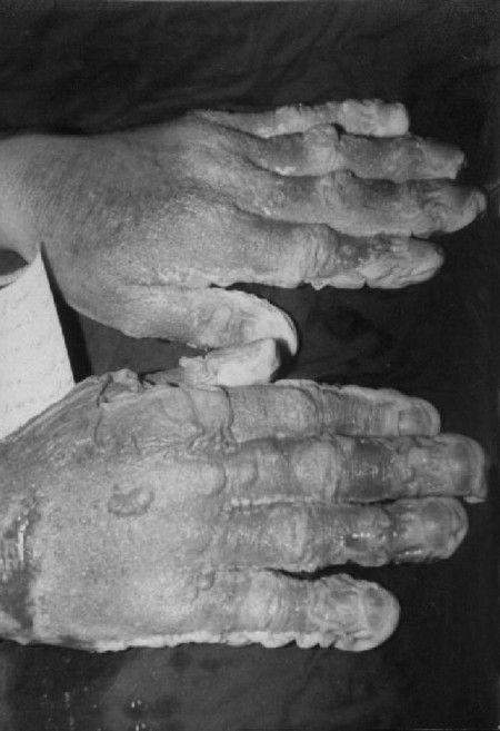 Fig. 3Bilateral burned hands showing maceration of skin of hand.