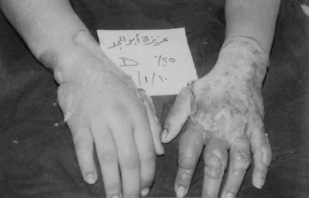 Fig. 4aDeep partial-thickness burned hand treated with 1% SSD.