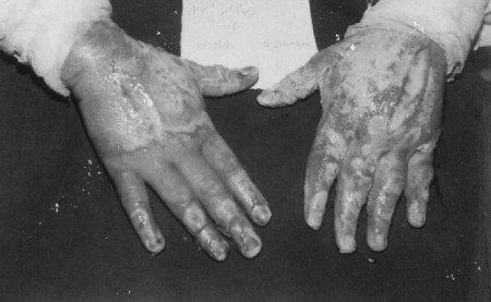 Fig. 5Bilateral deep partial-thickness burned hand (right side healed faster with MEBO).