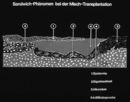 Fig. 1 Schematic representation of the �sandwich phenomenon�, incorporation of the allochorion: 1 = epidermis, 2 = autologous islands, 3 = allochorion, 4 = neochorion