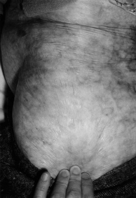 Fig. 6 The intermingled skin graft obtains part of its basic elasticity from the elastic fibres of the allodermis that survive.