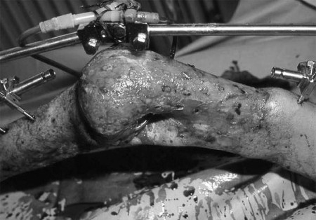 Fig. 7 After debridement of the patient�s left knee joint, a Fixateur was installed to stabilize it.