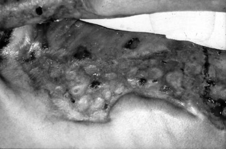 Fig. 8 Allograft skin with autologous split-thickness skin islands, taken from the patient�s scalp.
