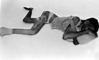 Fig. 1Patient with right thigh ulcer lying chronically ill.