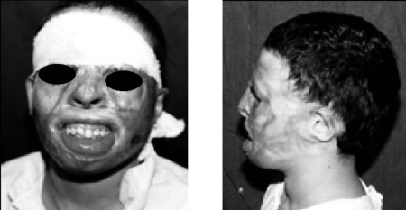 Fig. 1 a,bYoung patient with post-burn deformed face.  a: anterior view; b: lateral view