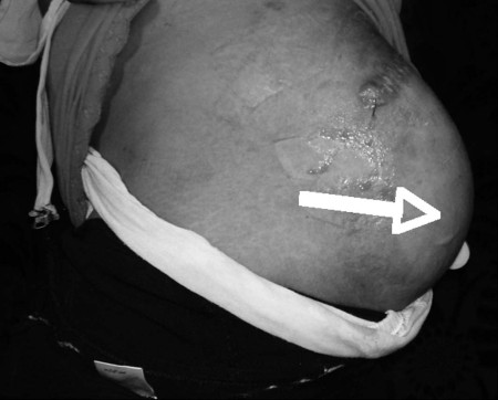 Fig. 2Full expansion of the superolateral aspect of the buttock.