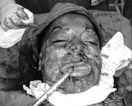 Fig. 3Facial scarring excised (intra-operative view).
