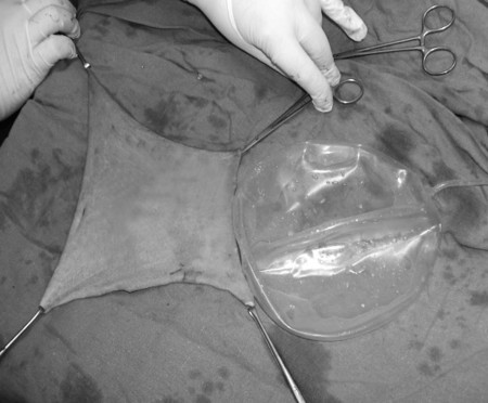 Fig. 4Expander deflated and delivered; the full-thickness expanded sheet taken.