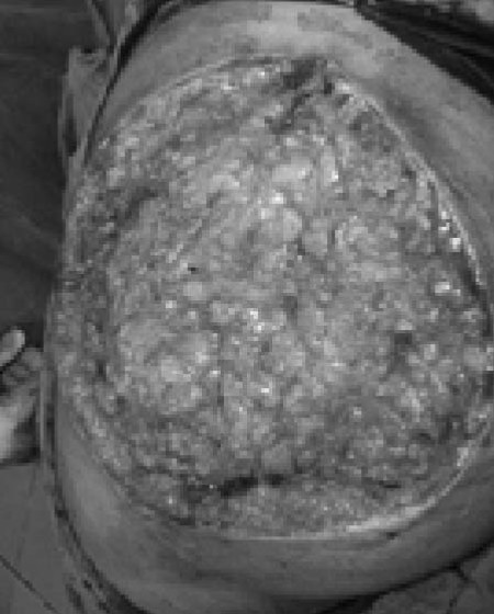 Fig. 5Defect left in buttock after taking the sheet.