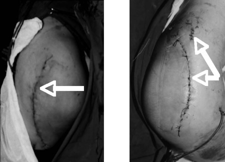 Fig. 7 a,ba: Donor site closed primarily. b: Local flap can help if the defect is wide.