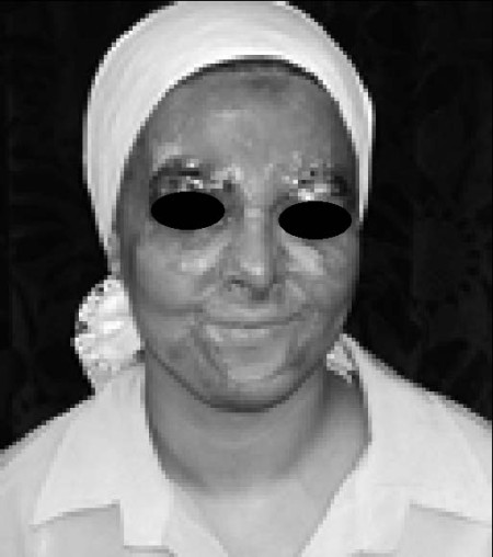 Fig. 8On follow-up, the patient with eyebrow reconstruction.