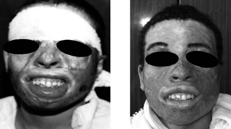 Fig. 9 a,bDonor-site-related complications. a: Pre-op. b: Post-op.