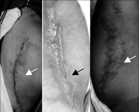 Fig. 10 a,bThe patient was satisfied with the new facial look (still in need of eyebrows). a: Wound haemotoma. b: Superficial disruption. c: Wide scar.