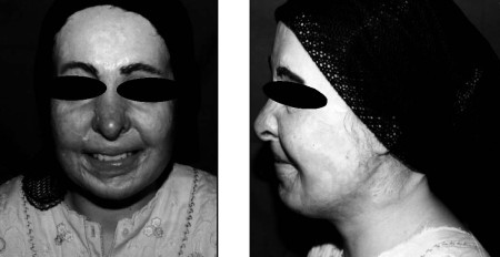 Fig. 11 a,bOn follow-up, the patient recovered some facial expression. a: Anterior view. b: Lateral view