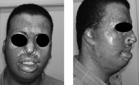 Fig. 12 a,bMale patient with late post-op follow-up. a: Anterior view. b: Lateral view.