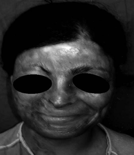 Fig. 13Female patient with final outcome. Anterior view. Pre-op.