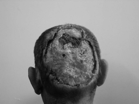 Fig. 6Patient aged 55 yr with very large Marjolin�s ulcer of the scalp arising in unstable scar tissue 45 yr after fungal infection treated with cauterization.