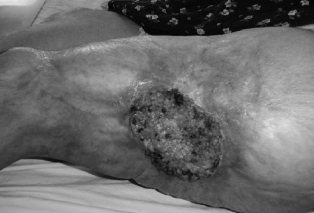 Fig. 7aMarjolin�s ulcer in 43-yr-old woman burned at age 3 yr and treated with home remedies.