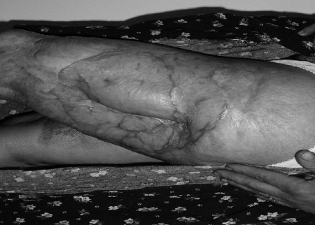 Fig. 7b Same case. Area of ulceration excised and reconstructed with split-thickness skin graft. Patient well two years later.