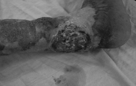 Fig. 8Woman aged 32 yr burned at age 2 yr and treated at home. Lag period of about 25 yr before breakdown. Area of ulceration present for about 5 yr. Tumour involving bone treated by amputation.