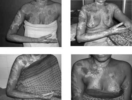 Fig. 1Patient treated with topical heparin for 7 days.