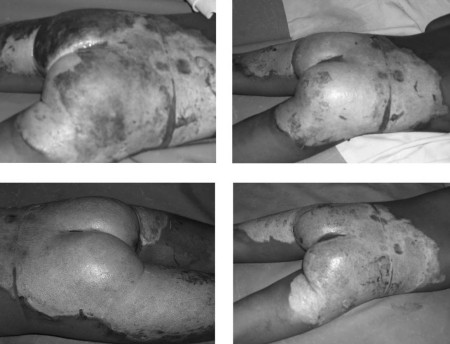 Fig. 3Patient treated with topical heparin.