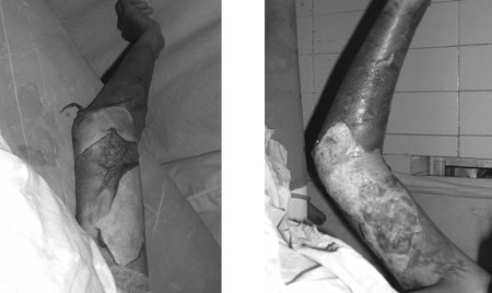 Fig. 5Control patient without heparin treatment.