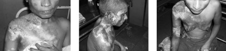 Fig. 6Patient treated with topical heparin.