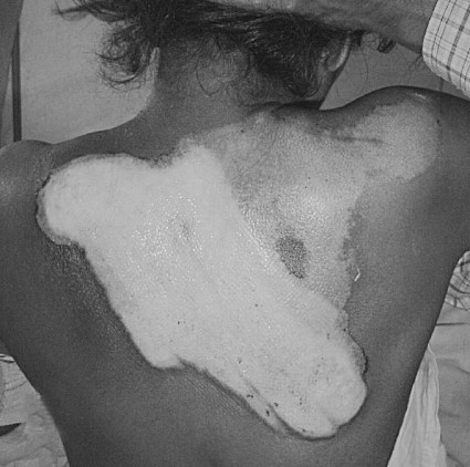 Fig. 4aFriction burn, back.