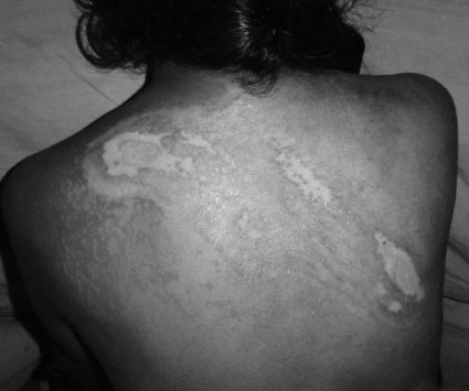 Fig. 4bHealing with silver sulphadiazine dressing one month follow-up.