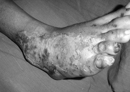 Fig. 5aFriction burn, dorsum foot.